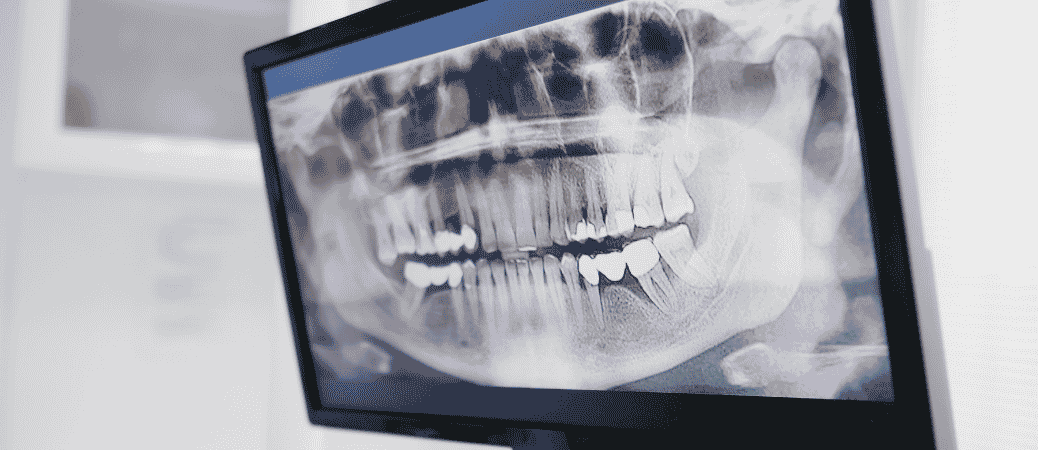 Early Signs Of Dental Implant Failure: Symptoms, Risk Factors, And Prevention